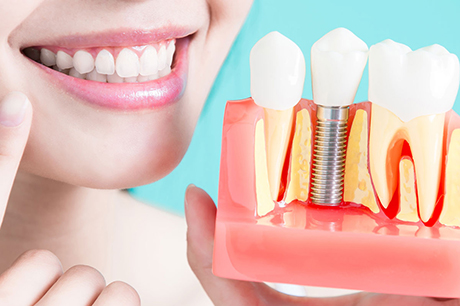 İmplant Yaptırmadan Önce Nelere Dikkat Etmeliyiz?